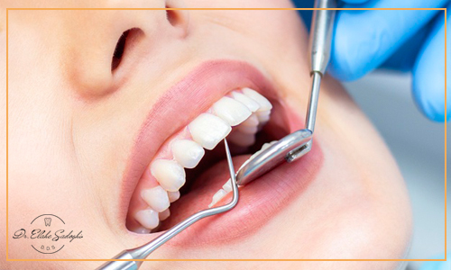 مراحل نصب لمینت دندان 