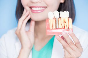 مزایای ایمپلنت دیجیتال دندان چیست؟