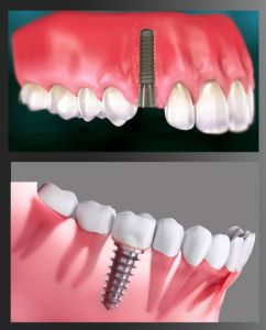 قرار دادن پایه ایمپلنت دندان