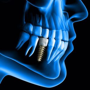 ایمپلنت دیجیتال دندان چیست
