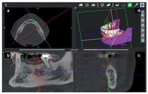 مراحل ایمپلنت دیجیتال دندان