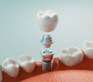  ایمپلنت دندان چیست