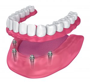   طول درمان ایمپلنت دندان
