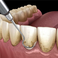 جرمگیری دندان با اولتراسونیک