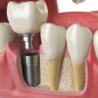 تفاوت بین ایمپلنت‌های دندانی دیجیتالی و سنتی