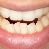 کجی دندانها