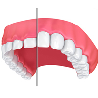 جراحی افزایش طول تاج دندان