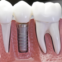 انواع متد های ایمپلنت دندان
