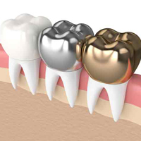 پروسه بازسازی تاج دندان